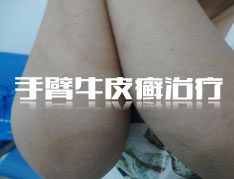 银屑病的症状有哪些？
